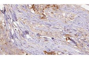 ABIN6267211 at 1/100 staining Human thyroid cancer tissue by IHC-P.