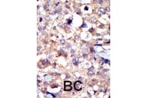 Formalin-fixed and paraffin-embedded human cancer tissue reacted with the primary antibody, which was peroxidase-conjugated to the secondary antibody, followed by AEC staining. (ABL1 抗体  (C-Term))