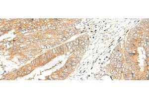 Immunohistochemistry of paraffin-embedded Human colorectal cancer tissue using GPR151 Polyclonal Antibody at dilution of 1:45(x200) (GPR151 抗体)
