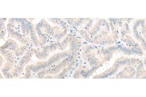 Immunohistochemistry of paraffin-embedded Human thyroid cancer tissue using AOAH Polyclonal Antibody at dilution of 1:25(x200) (AOAH 抗体)