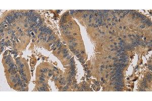 Immunohistochemistry of paraffin-embedded Human colon cancer using KIF22 Polyclonal Antibody at dilution of 1:30 (KIF22 抗体)