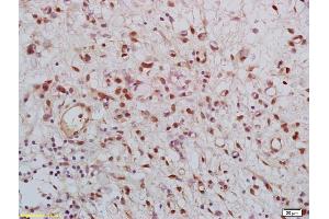 Formalin-fixed and paraffin embedded human gastric carcinoma labeled with Rabbit Anti KLK8 Polyclonal Antibody, Unconjugated (ABIN759116) at 1:200 followed by conjugation to the secondary antibody and DAB staining (Kallikrein 8 抗体  (AA 51-150))