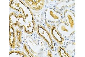 Immunohistochemistry of paraffin-embedded Human kidney cancer using GLRX Polyclonal Antibody at dilution of 1:200 (40x lens). (Glutaredoxin 1 抗体)