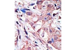 Formalin-fixed, Paraffin-embedded human cancer tissue stained with MAPK10 Antibody (N-term) Cat. (MAPK10 抗体  (N-Term))