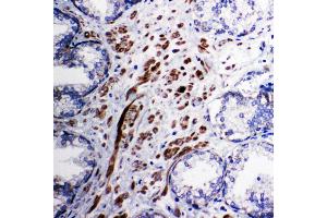 Anti-Mitochondrial Pyruvate dehydrogenase kinase 1 antibody, IHC(P) IHC(P): Human Prostatic Cancer Tissue