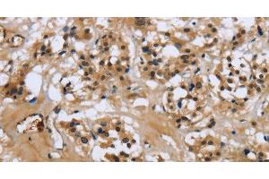Immunohistochemistry of paraffin-embedded Human thyroid cancer tissue using LGALS7 Polyclonal Antibody at dilution 1:50 (LGALS7 抗体)