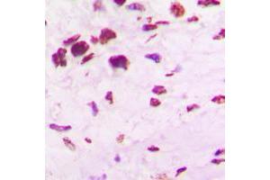 Immunohistochemical analysis of OCT4 staining in human lung cancer formalin fixed paraffin embedded tissue section.