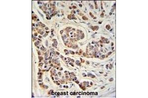 ATHL1 Antibody (C-term) (ABIN1881084 and ABIN2840111) IHC analysis in formalin fixed and paraffin embedded human breast carcinoma followed by peroxidase conjugation of the secondary antibody and DAB staining. (ATHL1 抗体  (C-Term))