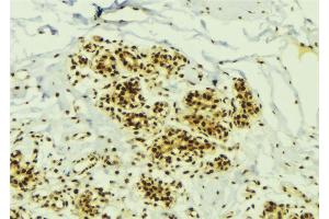 ABIN6273799 at 1/100 staining Human breast cancer tissue by IHC-P. (NEK2 抗体  (Internal Region))