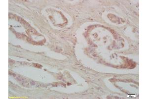 Formalin-fixed and paraffin embedded human colon carcinoma labeled with Rabbit Anti IRS-2 Polyclonal Antibody, Unconjugated (ABIN725840) at 1:200 followed by conjugation to the secondary antibody and DAB staining (IRS2 抗体  (AA 501-600))