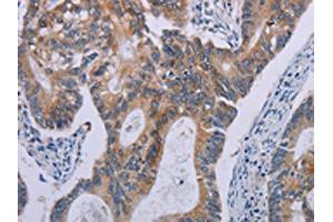 The image on the left is immunohistochemistry of paraffin-embedded Human colon cancer tissue using ABIN7190614(F2RL2 Antibody) at dilution 1/30, on the right is treated with synthetic peptide. (F2RL2 抗体)