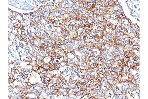 Formalin-fixed, paraffin-embedded human Breast Carcinoma stained with EpCAM Mouse Monoclonal Antibody (EGP40/826). (EpCAM 抗体  (N-Term))
