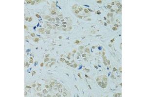Immunohistochemistry of paraffin-embedded human breast cancer using RCC1 antibody. (RCC1 抗体  (AA 1-240))