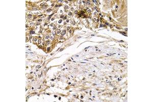 Immunohistochemistry of paraffin-embedded human breast cancer using ARRB2 antibody at dilution of 1:200 (400x lens). (Arrestin 3 抗体)