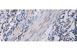 Immunohistochemistry of paraffin-embedded Human esophagus cancer tissue using ANGPTL2 Polyclonal Antibody at dilution of 1:55(x200) (ANGPTL2 抗体)