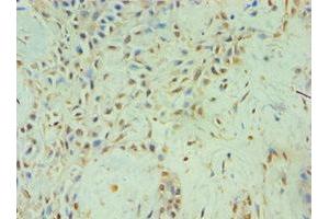 Immunohistochemistry of paraffin-embedded human breast cancer using ABIN7152459 at dilution of 1:100 (TBL1XR1 抗体  (AA 1-180))