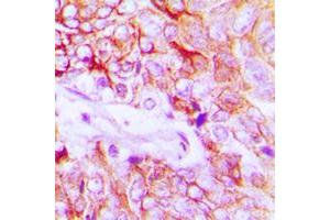 Immunohistochemical analysis of HER4 (pY1284) staining in human breast cancer formalin fixed paraffin embedded tissue section. (ERBB4 抗体  (C-Term, pTyr1284))