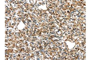 The image on the left is immunohistochemistry of paraffin-embedded Human prostate cancer tissue using ABIN7131341(TGM4 Antibody) at dilution 1/20, on the right is treated with fusion protein. (TGM4 抗体)
