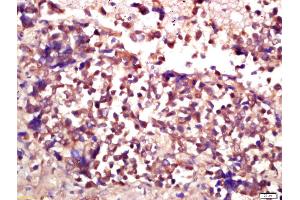 Formalin-fixed and paraffin embedded human lung carcinoma labeled with Anti-E2F3 Polyclonal Antibody, Unconjugated (ABIN733493) at 1:200 followed by conjugation to the secondary antibody and DAB staining (E2F3 抗体  (AA 381-465))