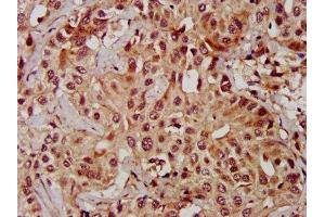 IHC image of ABIN7159972 diluted at 1:600 and staining in paraffin-embedded human liver cancer performed on a Leica BondTM system. (ERK2 抗体  (AA 310-360))