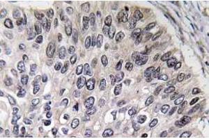 Immunohistochemistry analyzes of Carbonic anhydrase 2 antibody in paraffin-embedded human lung carcinoma tissue. (CA2 抗体)