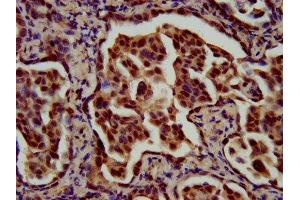 IHC image of ABIN7159682 diluted at 1:700 and staining in paraffin-embedded human lung cancer performed on a Leica BondTM system. (RFX1 抗体  (AA 36-133))