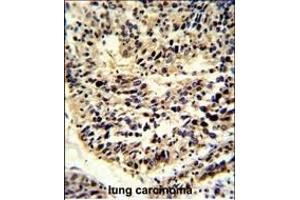 Formalin-fixed and paraffin-embedded human lung carcinoma reacted with BCL2A1 Antibody (Center), which was peroxidase-conjugated to the secondary antibody, followed by DAB staining. (BCL2A1 抗体  (AA 53-81))