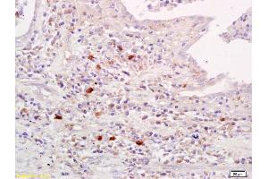 Formalin-fixed and paraffin embedded human lung carcinoma labeled with Anti-Amylin Polyclonal Antibody, Unconjugated (ABIN724280) at 1:200 followed by conjugation to the secondary antibody and DAB staining. (Amylin/DAP 抗体)