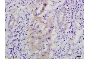 Formalin-fixed and paraffin embedded human hepatoma labeled with Anti-phospho C-Met/HGFR(Tyr1365), Unconjugated (ABIN733703) at 1:200, followed by conjugation to the secondary antibody and DAB staining (MEK1 抗体  (pSer298))