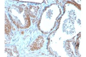 Formalin-fixed, paraffin-embedded human Prostate Carcinoma stained with TIGIT-Monospecific Mouse Monoclonal Antibody (TIGIT/3106). (TIGIT 抗体  (AA 22-141))