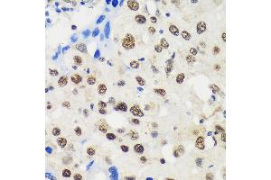 Immunohistochemistry of paraffin-embedded Human breast cancer using LB Rabbit pAb (ABIN6131871, ABIN6143090, ABIN6143091 and ABIN6217142) at dilution of 1:100 (40x lens). (LARP1B 抗体  (AA 170-320))