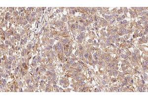 ABIN6279662 at 1/100 staining Human Melanoma tissue by IHC-P. (GPLD1 抗体  (Internal Region))