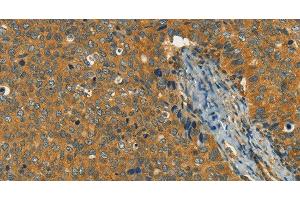 Immunohistochemistry of paraffin-embedded Human cervical cancer using KLC1 Polyclonal Antibody at dilution of 1:40 (KLC1 抗体)