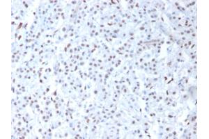 Formalin-fixed, paraffin-embedded human Mesothelioma stained with Wilm's Tumor Mouse Monoclonal Antibody (6F-H2). (WT1 抗体  (AA 1-181))