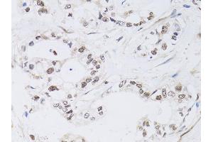 Immunohistochemistry of paraffin-embedded human gastric cancer using PAX3 antibody (ABIN6290725) at dilution of 1:100 (40x lens). (Paired Box 3 抗体)