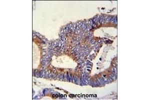 HS Antibody (C-term) (ABIN651231 and ABIN2840143) immunohistochemistry analysis in formalin fixed and paraffin embedded human colon carcinoma followed by peroxidase conjugation of the secondary antibody and DAB staining.