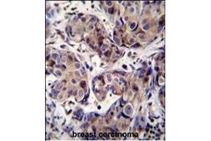 GEA3 Antibody (C-term) (ABIN390107 and ABIN2840619) immunohistochemistry analysis in forlin fixed and paraffin embedded hun breast carcino followed by peroxidase conjugation of the secondary antibody and DAB staining. (MAGEA3 抗体  (C-Term))