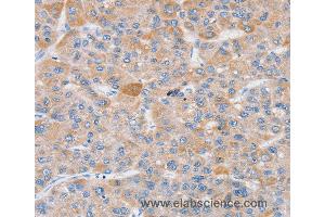 Immunohistochemistry of Human liver cancer using SLC25A13 Polyclonal Antibody at dilution of 1:35 (slc25a13 抗体)