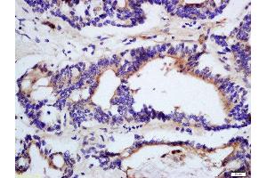 Formalin-fixed and paraffin embedded human colon cancer tissue labeled with Rabbit Anti-DHDH Polyclonal Antibody, Unconjugated (ABIN2559590) at 1:200 followed by conjugation to the secondary antibody and DAB staining (DHDH 抗体  (AA 281-334))