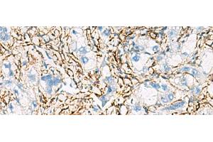 Immunohistochemistry of paraffin-embedded Human liver cancer tissue using ACTC1 Polyclonal Antibody at dilution of 1:55(x200) (ACTC1 抗体)