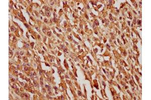 IHC image of ABIN7163445 diluted at 1:100 and staining in paraffin-embedded human melanoma cancer performed on a Leica BondTM system.