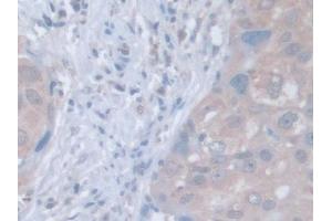 IHC-P analysis of Human Breast cancer Tissue, with DAB staining. (LDOC1 抗体  (AA 1-146))