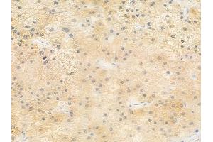 ABIN6257072 and ABIN6273592 at 1/100 staining human hepatocellular carcinoma by IHC-P.