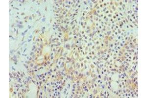 Immunohistochemistry of paraffin-embedded human breast cancer using ABIN7155972 at dilution of 1:100 (HYAL3 抗体  (AA 198-417))