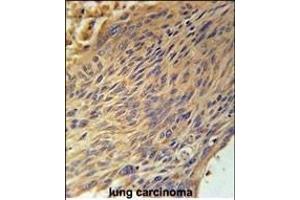 CPEB4 Antibody (N-term) (ABIN651815 and ABIN2840408) immunohistochemistry analysis in formalin fixed and paraffin embedded human lung carcinoma followed by peroxidase conjugation of the secondary antibody and DAB staining. (CPEB4 抗体  (N-Term))