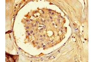 Immunohistochemistry of paraffin-embedded human breast cancer using ABIN7143311 at dilution of 1:100 (AHCY 抗体  (AA 2-432))