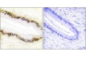 Immunohistochemistry analysis of paraffin-embedded human cervix carcinoma tissue, using NR2F6 Antibody. (NR2F6 抗体  (AA 11-60))