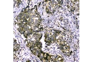 IHC testing of FFPE human breast cancer tissue with MYBPC3 antibody at 1ug/ml. (MYBPC3 抗体)