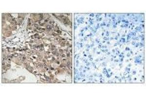 Immunohistochemistry analysis of paraffin-embedded human breast carcinoma tissue using MAP3K7 (Ab-187) antibody. (MAP3K7 抗体  (Thr187))