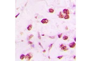 Immunohistochemical analysis of DLX5 staining in human lung cancer formalin fixed paraffin embedded tissue section. (DLX5 抗体  (Center))